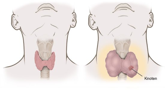 Illustration: Normal thyroid (left) and thyroid gland that is making too many hormones (right)