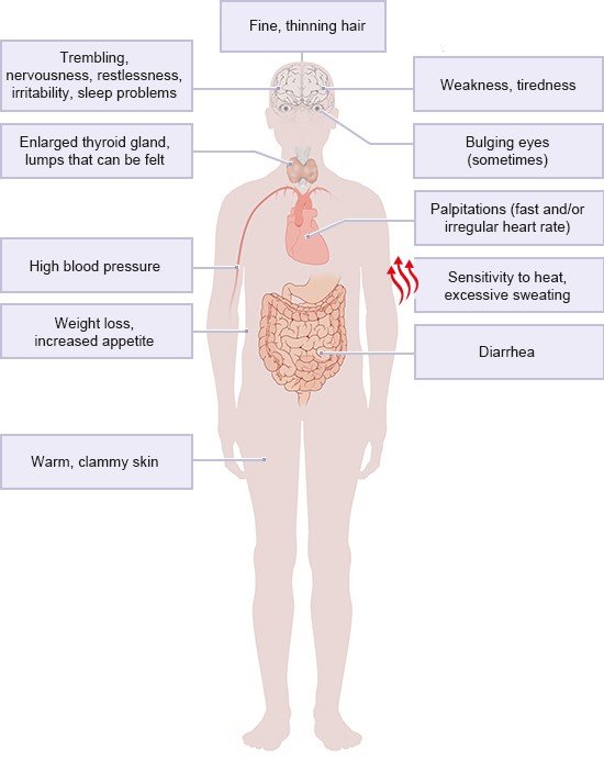 Illustration: Possible symptoms of an overactive thyroid