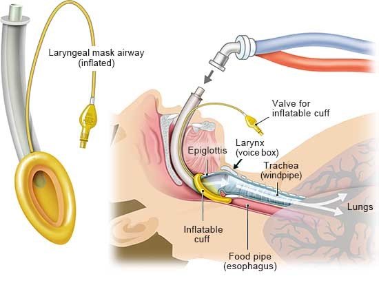This illustration shows how ventilation is done using a laryngeal mask. This mask is inserted into the throat above the larynx.