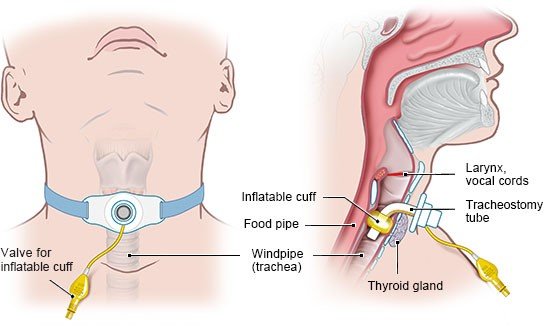 The illustration on the left shows the front view of an artificial opening in the windpipe. The illustration on the right shows the side view of a tracheostomy leading to the airways.