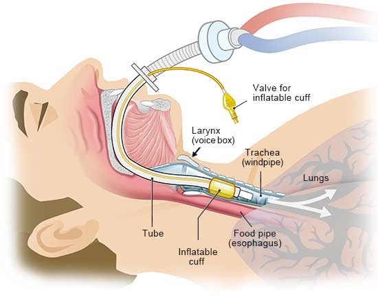 This illustration shows how ventilation is done using intubation. A flexible plastic tube is used to direct air right into the windpipe.