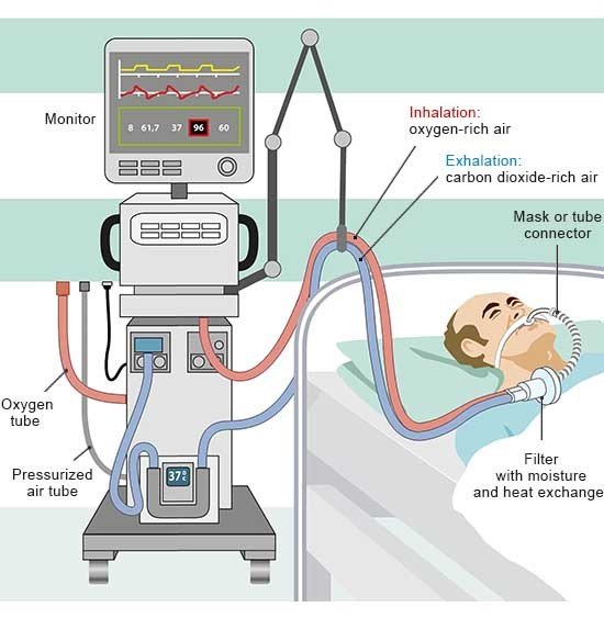This illustration shows how a ventilator pumps air into the lungs via tubes. The ventilation can be controlled on the device.