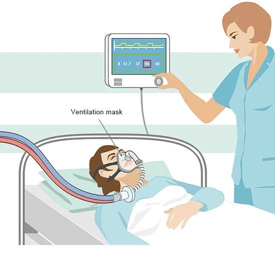This illustration shows how ventilation is done using a mask. The ventilation mask covers the nose and mouth and is connected to a ventilator.