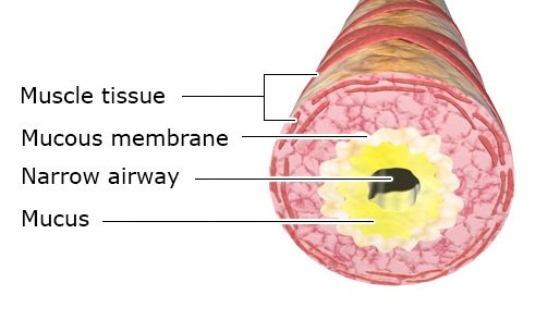 The illustration shows a cross-section of an airway that is narrowed by a thick layer of mucus.