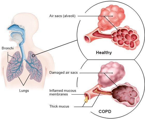 The illustration shows the lungs with the bronchi on the left. On the upper right there's an enlarged view of healthy air sacs, with damaged air sacs shown below them.
