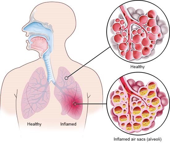 This simplified anatomical illustration shows pneumonia in the left lung. On the right side of the illustration there is a detailed view of healthy and inflamed alveoli.