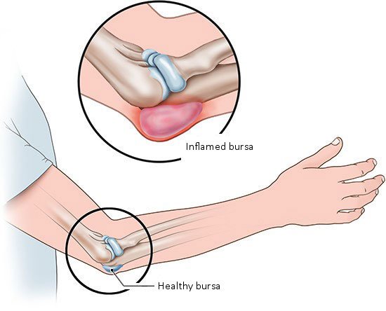 This illustration shows a forearm with a healthy (below) and inflamed (above) elbow bursa