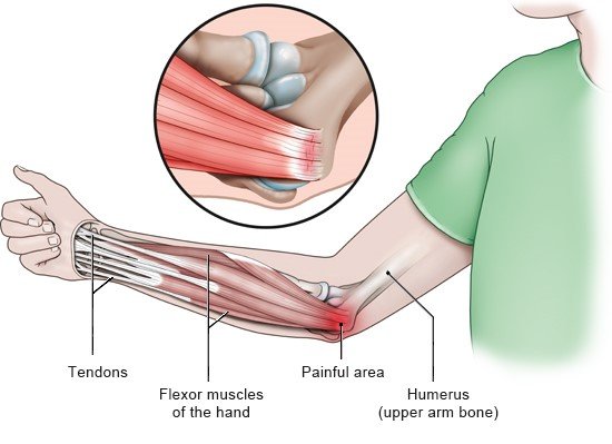 This illustration shows the inside of the elbow – where golfer’s elbow causes pain – and where the tendons attach to the elbow (in detail).