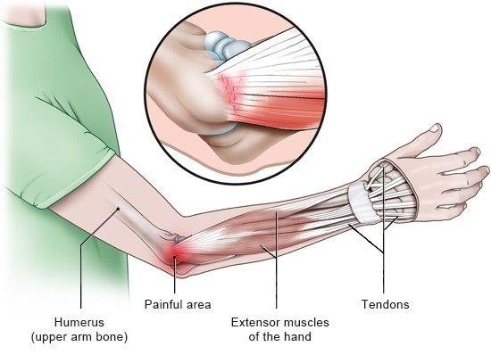This illustration shows the outside of the elbow – where tennis elbow causes pain – and where the tendons attach to the elbow (in detail).