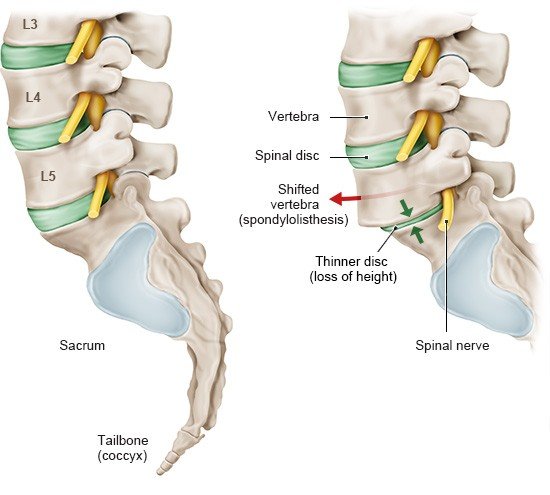Illustration: Spondylolisthesis: A healthy lumbar spine on the left, a slipped vertebra on the right (side view)