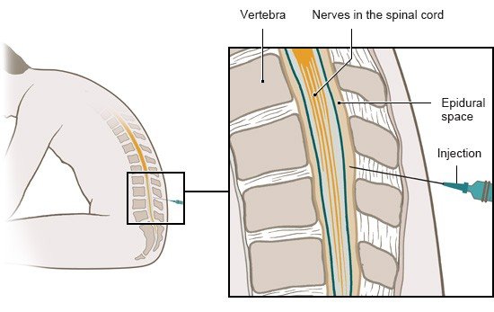 Die Grafik zeigt, wie eine wirbelsäulennahe Kortisonspritze in den Epiduralraum gesetzt wird.