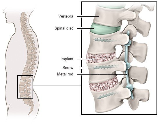 Die Grafik zeigt das Vorgehen bei einer Wirbelkörperversteifung mit Detailansicht von Wirbelkörper, Bandscheibe, Ersatzmaterial sowie Schrauben und Metallstab.