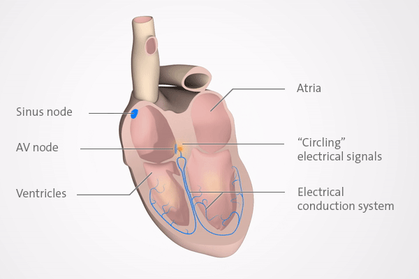 Illustration: If electrical signals circle around the AV node, the heart beats too fast