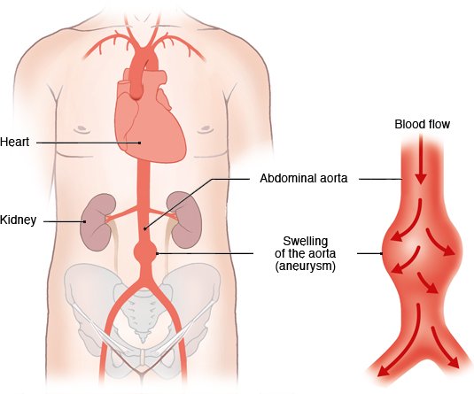 The illustration on the left shows the position of an abdominal aortic aneurysm in the body. The right side shows the flow of blood through the bulging vessel wall.