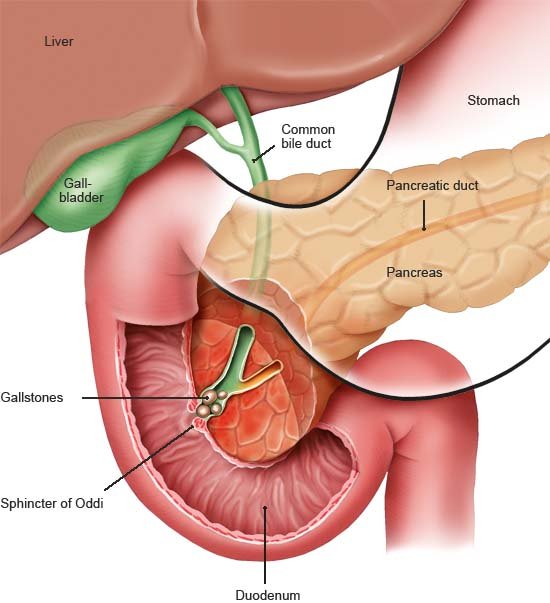 This simplified anatomical illustration shows a cross-sectional view of the bile duct and the pancreatic duct with gallstones blocking them.