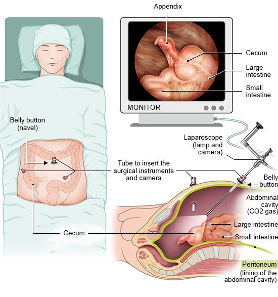 This illustration shows therapeutic laparoscopy, which makes it possible to provide surgical treatment directly – this is an example involving appendicitis.