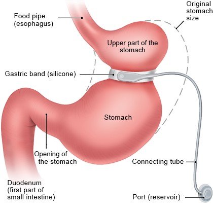Illustration: Gastric band