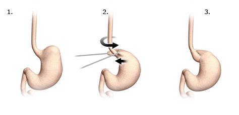 Illustration: Nissen fundoplication: The upper part of the stomach is wrapped around the lower end of the food pipe like a collar.
