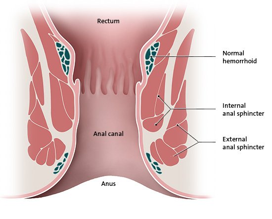 This anatomical illustration shows the lower end of the gastrointestinal tract, which includes the rectum, the anal canal, the anal sphincter muscles and hemorrhoids.