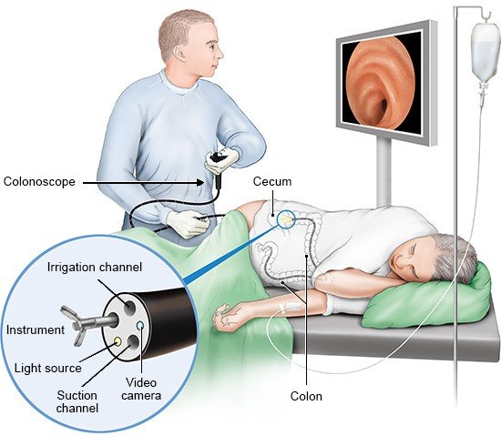 Illustration: During a colonoscopy – as described in the article