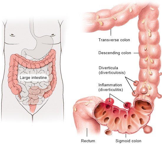 The simplified anatomical illustration shows the position of the large intestine in the body (left) and the sigmoid colon with diverticula and diverticulitis.