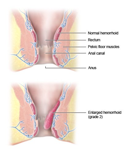 This two-part simplified anatomical illustration shows the hemorrhoid tissue in cross section. The top part shows healthy tissue. The lower part of the illustration shows an enlarged hemorrhoid (grade 2) pushing into the anal canal. 