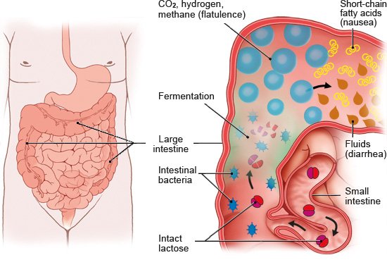 This illustration shows the anatomy of the digestive system (left), and how lactose is broken down in the large intestine with the resulting symptoms (right).
