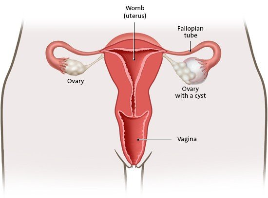 This simplified anatomical illustration shows an ovary with an ovarian cyst (on the right)