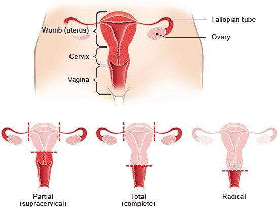 The upper half of this illustration shows the anatomy of the womb (uterus). The lower half depicts the three ways that the womb can be removed (hysterectomy).