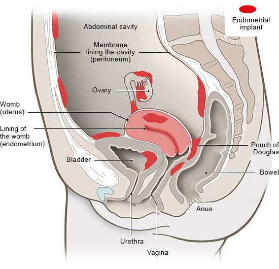 This anatomical illustration of the female abdomen, seen from the side, shows where endometriosis tissue might grow in the abdominal cavity.