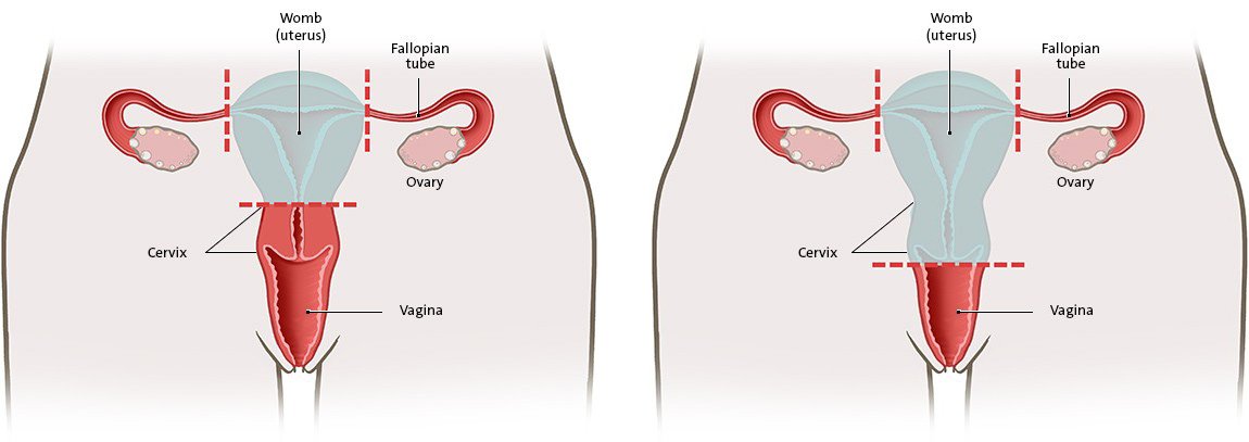 The anatomical illustration on the left shows a partial (supracervical) hysterectomy, and the illustration on the right shows a total (complete) hysterectomy.