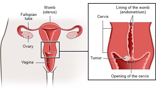The anatomical illustration on the left shows the internal female sex organs. The illustration on the right shows the cervix and opening of the cervix.