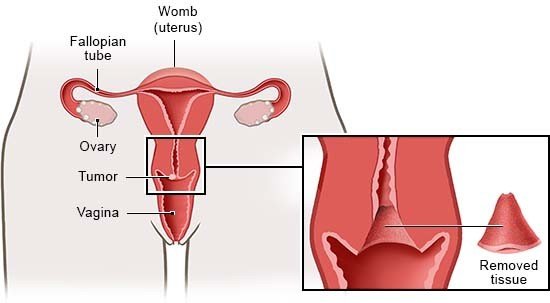 The illustration on the left shows the internal sex organs and a tumor on the opening of the cervix; the illustration on the right shows the cervix after tissue has been removed.