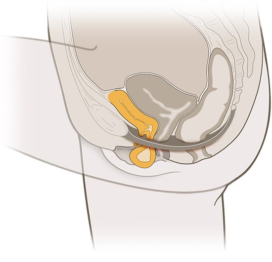 This is a simplified anatomical illustration of a bladder prolapse (in yellow).