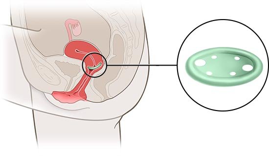 This is a simplified anatomical illustration of a saucer-shaped pessary (detailed view in green), showing its position in the female body.