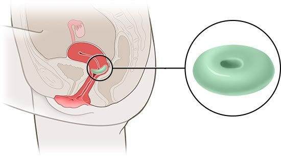 This is a simplified anatomical illustration of a ring pessary (detailed view in green), showing its position in the female body.
