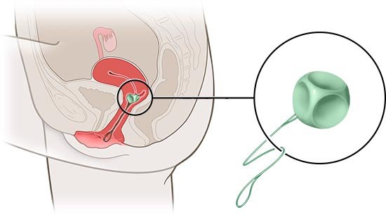 This is a simplified anatomical illustration of a cube pessary (detailed view in green), showing its position in the female body.