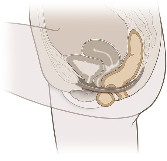 This is a simplified anatomical illustration of a rectal prolapse (in beige).