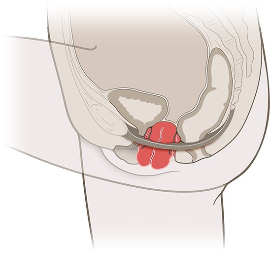 This is a simplified anatomical illustration of a uterine prolapse (in red).