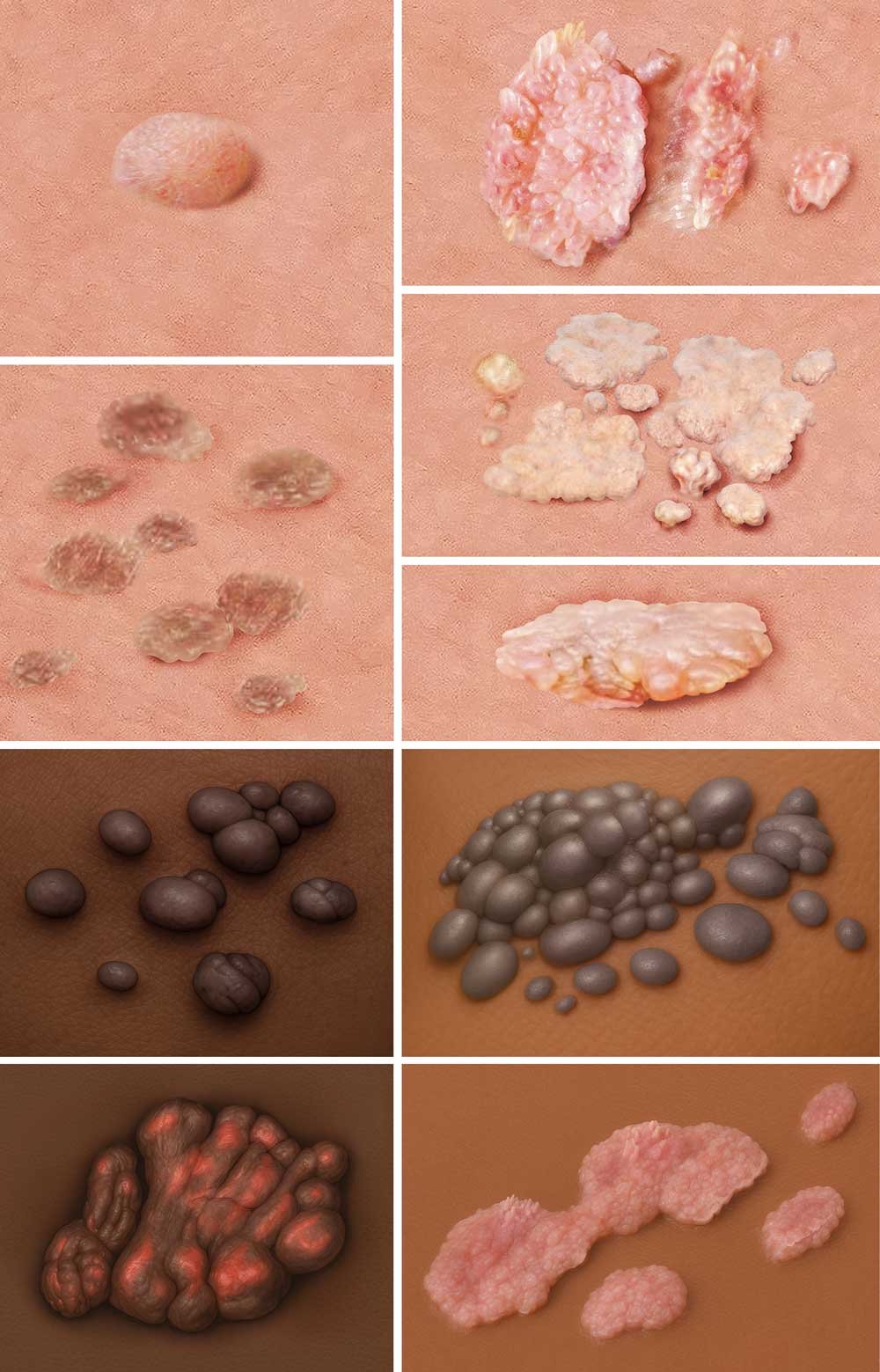 The photorealistic images show how the appearance of genital warts can vary.