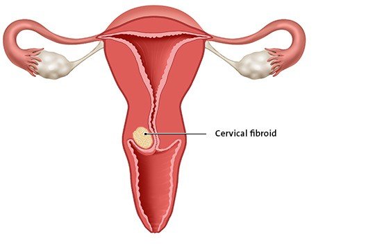 This anatomical illustration shows a cervical fibroid. This kind of fibroid is found in the cervix.