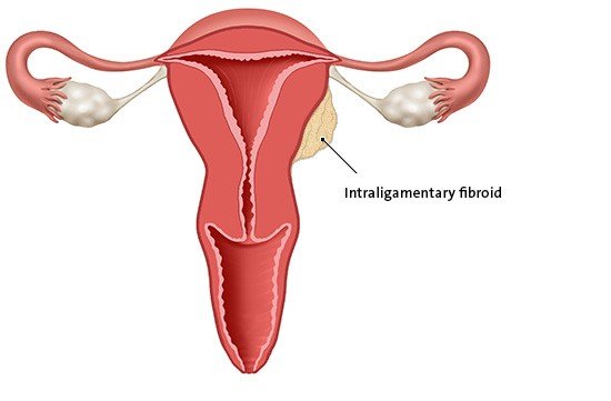 This anatomical illustration shows a cervical fibroid. This kind of fibroid is found in the cervix.