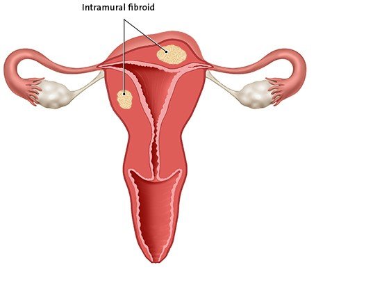 This anatomical illustration shows an intramural fibroid. It is in the wall of the womb.