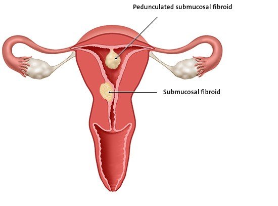 This anatomical illustration shows a submucosal fibroid and a pedunculated submucosal fibroid. The fibroids are directly under the lining of the womb.