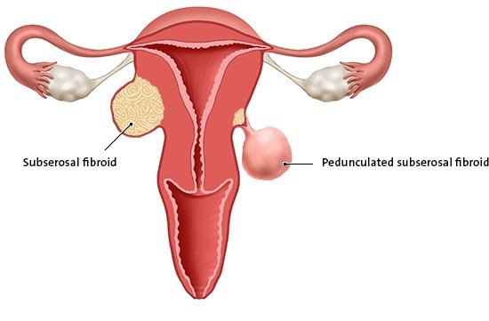 This anatomical illustration shows a subserosal fibroid and a pedunculated subserosal fibroid. They are both on the outside of the womb.