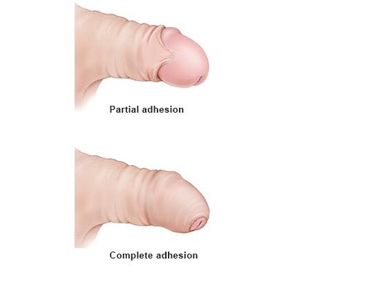 Illustration: Phimosis: Adhesion between the foreskin and the head of the penis (glans)