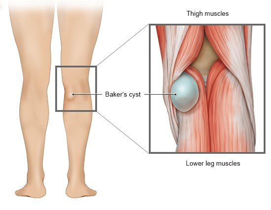 The illustration on the left shows the back of the knee with a Baker's cyst. The illustration on the right shows the location of the cyst between the thigh and calf muscles.