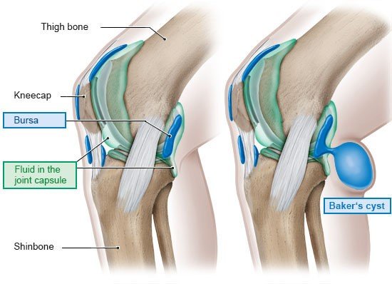 The illustration on the left shows a healthy knee joint. The illustration on the right shows a knee with a Baker's cyst in the back of the knee.