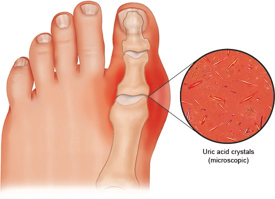 Illustration: In gout, tiny uric acid crystals build up in the body, mainly in the joints
