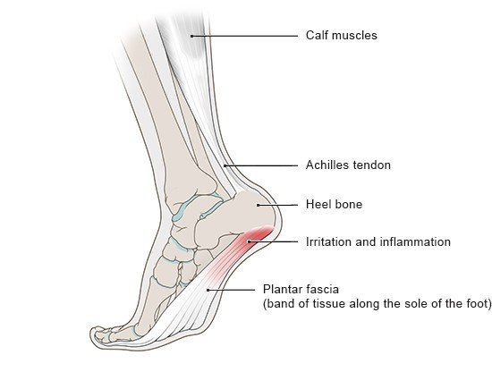 This simplified anatomical illustration depicts a foot with calf muscles, Achilles tendon, heel bone and plantar fascia in which plantar fasciitis has been caused by inflammation.